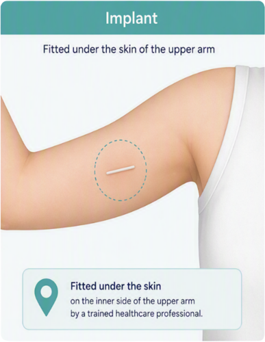 Implant, fitted under the skin of the upper arm