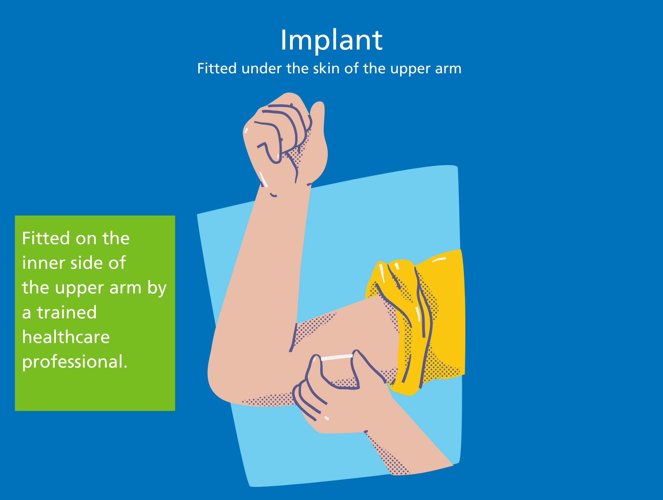 Implant Diagram