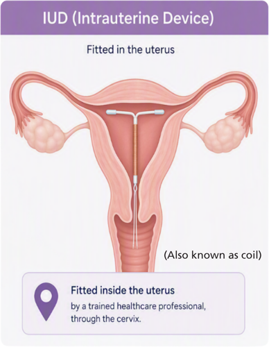 IUD (Intrauterine Device), fitted in the uterus